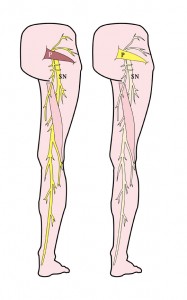 information about sciatica and piriformis syndrome