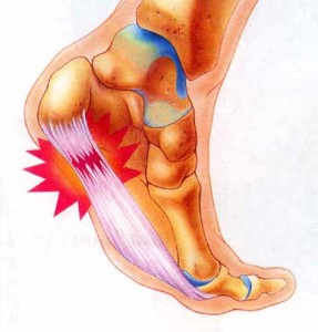 plantar fasciitis and its symptoms