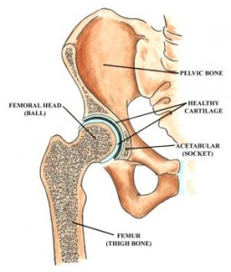 hip impingement