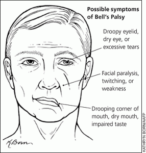 Bell's Palsy: I am not this Body