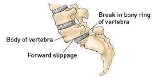 spondylolisthesis