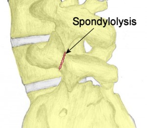 sponylolysis