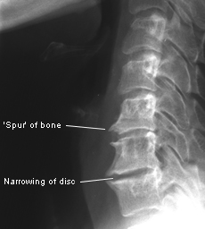 Spondylosis, Spondylolysis and Spondylolisthesis