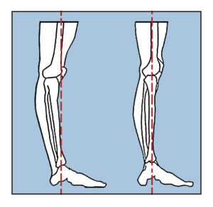 Hyperextension of the knees
