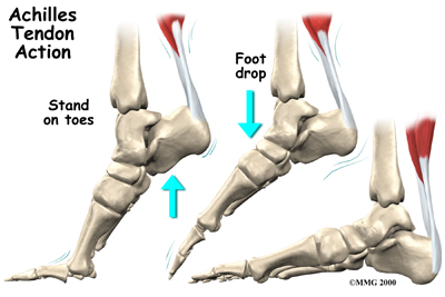 Achilles tendon sales always tight