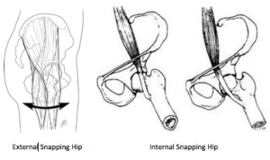 Left Snapping Hip Snapping Hip Syndrome: What Is That Weird Pop?