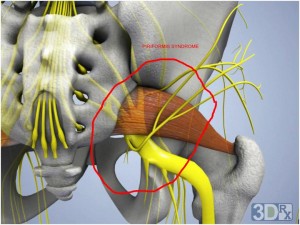 sciatic nerve and numbness in the foot