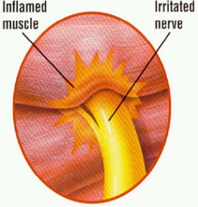 sciatic nerve and numbness in the foot