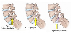 The lumbar curve of the spine