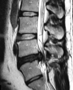 The lumbosacral joint