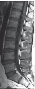 normal lumbar spine