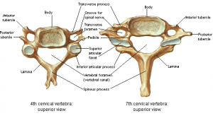 cervical spinal stenosis