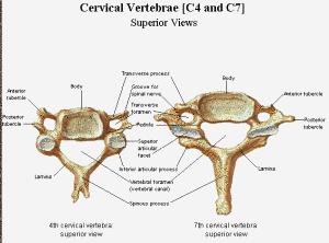 cervical spinal stenosis