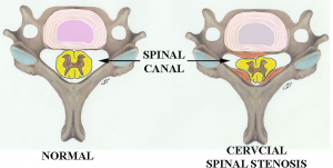 Cervical Spinal Stenosis