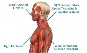 upper cross syndrome