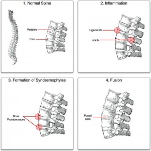 What is Ankylosing Spondylitis