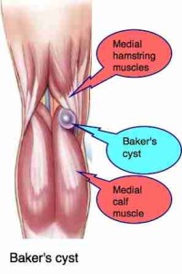 Bakers-cyst