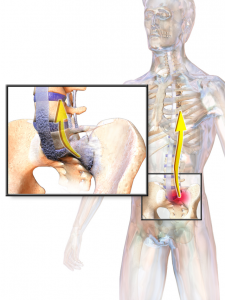 What is Ankylosing Spondylitis