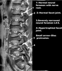 spinal stenosis