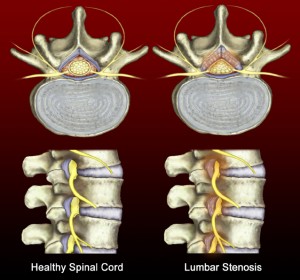 spinal stenosis