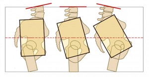 psoas erector spinea lower back pain