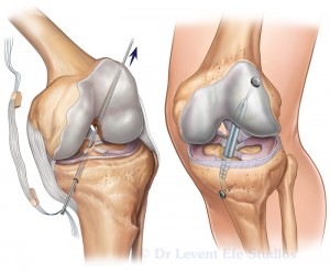 ACL-repair_illustration3