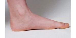 build arches in flat feet