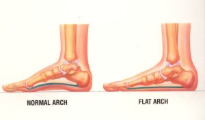 build arches in flat feet