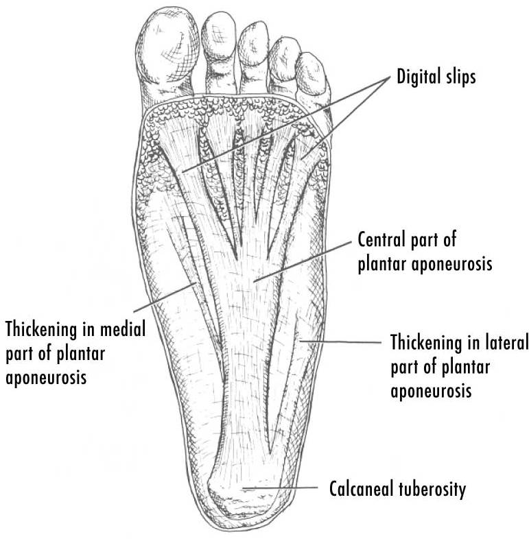 plantar fasciits