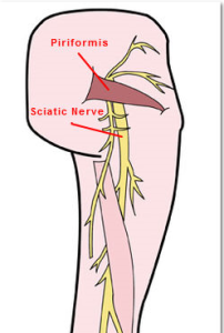 sciatica