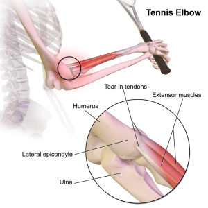 Tennis_Elbow