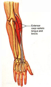 tennis elbow