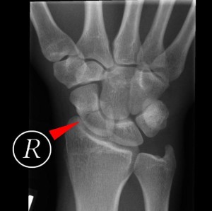 The Scaphoid Bone of the Wrist - CoreWalking