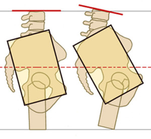 lumbar spine meets the sacrum