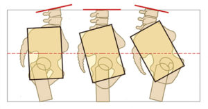 neutral pelvis