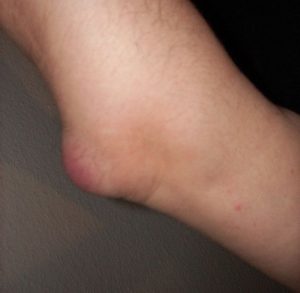 olecranon bursitis