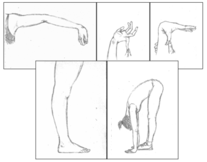 joint hypermobility