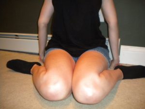 joint hypermobility