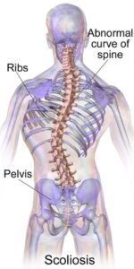 scoliosis basics
