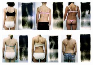 personalized scoliosis treatment