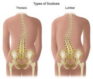 what causes scoliosis