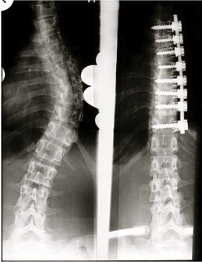 Diagnosis and Treatment of Scoliosis