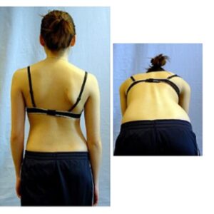 Diagnosis and Treatment of Scoliosis