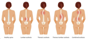 Side Planks and Scoliosis